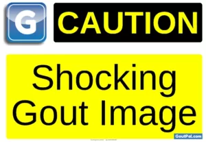 Shocking Gout Image