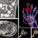 Gout Tests