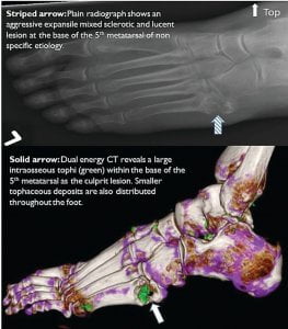 Bone Erosion from Gouty Tophi