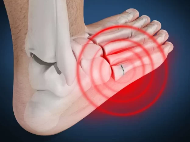 Broken Bone or Gout Pain?